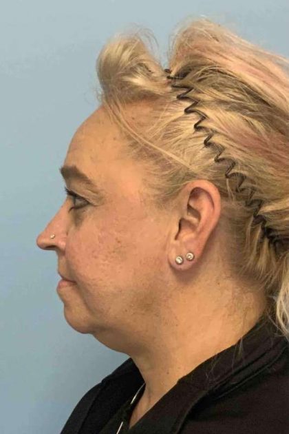 Facelift Before & After Patient #11424