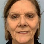 Facelift Before & After Patient #11443