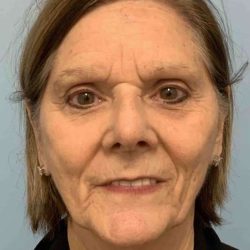 Facelift Before & After Patient #11443