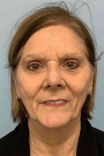 Facelift Before & After Patient #11443