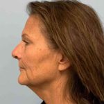 Facelift Before & After Patient #11450