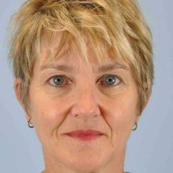 Facelift Before & After Patient #11457