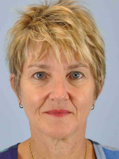 Facelift Before & After Patient #11457