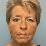 Eyelid Surgery Before & After Patient #11476