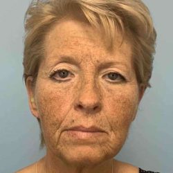 Eyelid Surgery Before & After Patient #11476