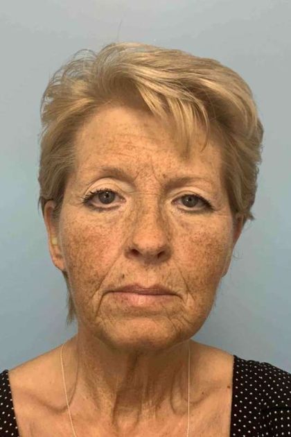 Eyelid Surgery Before & After Patient #11476