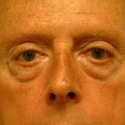 Eyelid Surgery Before & After Patient #11497
