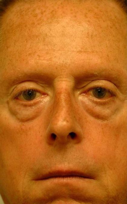 Eyelid Surgery Before & After Patient #11497