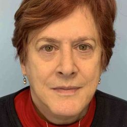 Eyelid Surgery Before & After Patient #11532