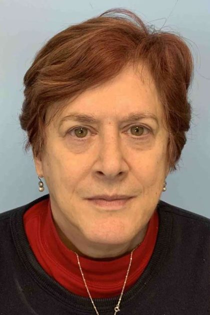 Eyelid Surgery Before & After Patient #11532