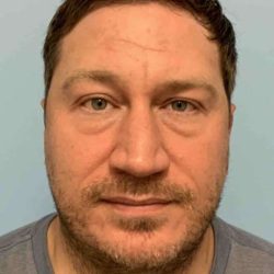 Eyelid Surgery Before & After Patient #11586