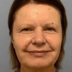 Eyelid Surgery Before & After Patient #11668