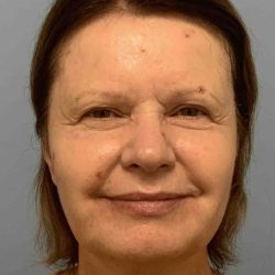 Eyelid Surgery Before & After Patient #11668