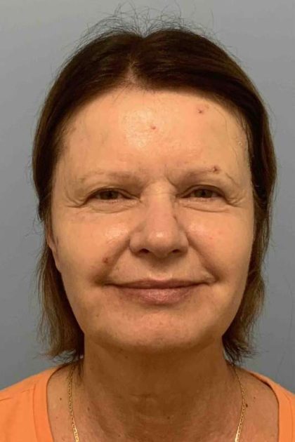Eyelid Surgery Before & After Patient #11668
