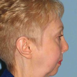 Chin Surgery Before & After Patient #11687