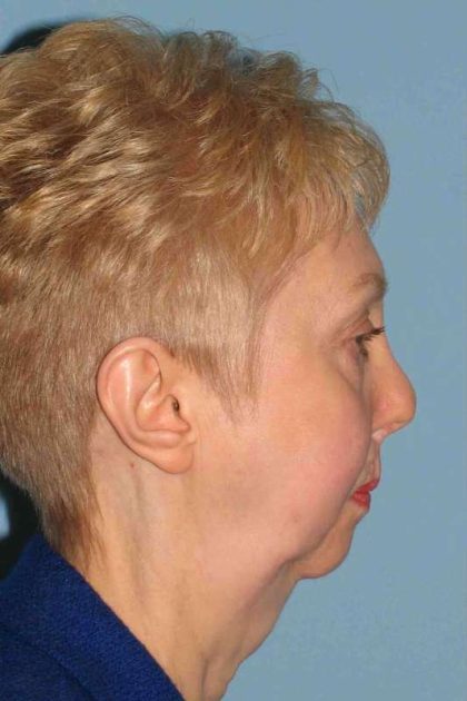 Chin Surgery Before & After Patient #11687