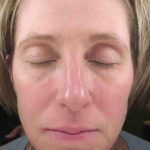 Chemical Peels Before & After Patient #11701