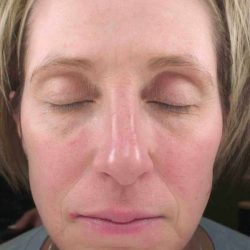 Chemical Peels Before & After Patient #11701