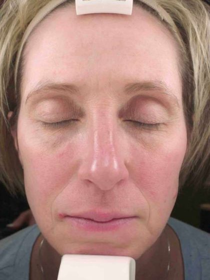 Chemical Peels Before & After Patient #11701