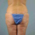 Buttocks Before & After Patient #11718