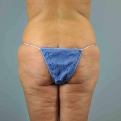 Buttocks Before & After Patient #11718