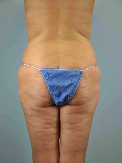 Buttocks Before & After Patient #11718