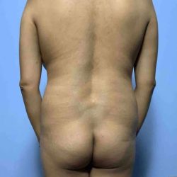 Buttocks Before & After Patient #11728
