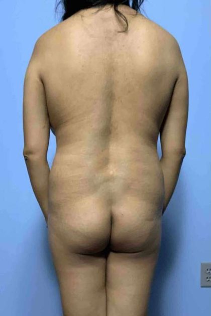 Buttocks Before & After Patient #11728