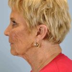 Brow Lift Before & After Patient #11742