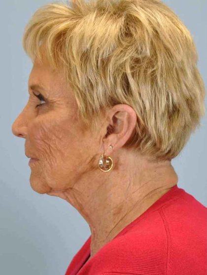 Brow Lift Before & After Patient #11742