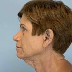 Brow Lift Before & After Patient #11779