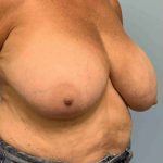 Breast Reduction Before & After Patient #11838