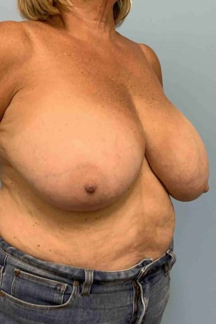 Breast Reduction Before & After Patient #11838
