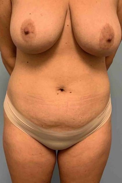 Breast Reduction Before & After Patient #11847
