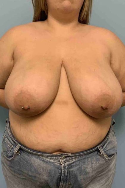 Breast Reduction Before & After Patient #11854