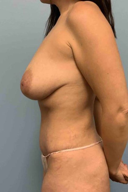 Breast Reduction Before & After Patient #11863