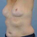Breast Reconstruction Before & After Patient #11884