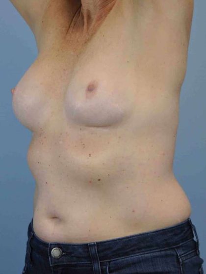 Breast Reconstruction Before & After Patient #11884