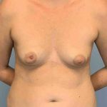 Breast Reconstruction Before & After Patient #11894