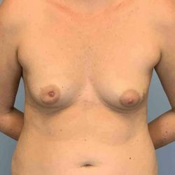 Breast Reconstruction Before & After Patient #11894