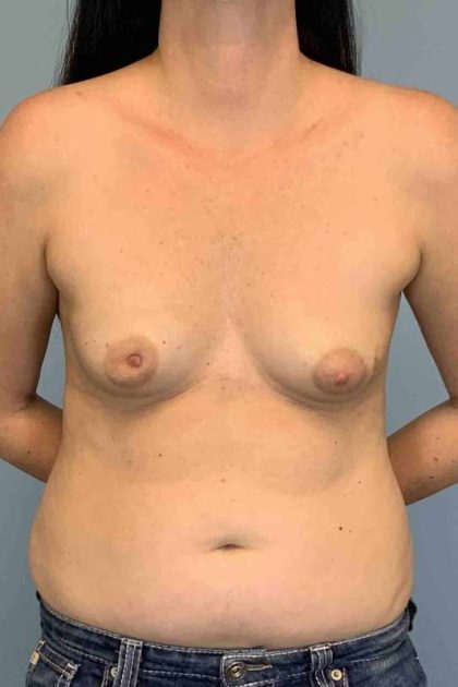 Breast Reconstruction Before & After Patient #11894