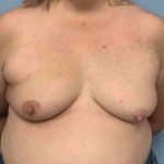 Breast Reconstruction Before & After Patient #11901