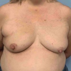 Breast Reconstruction Before & After Patient #11901