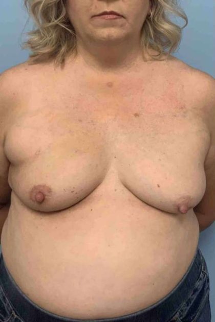 Breast Reconstruction Before & After Patient #11901