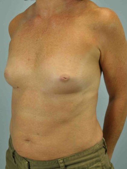 Breast Reconstruction Before & After Patient #11908