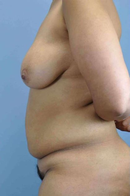 Breast Lift Before & After Patient #11994