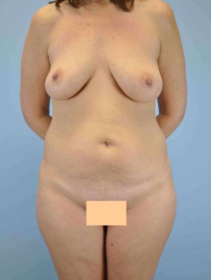 Breast Lift Before & After Patient #12001