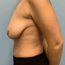 Breast Lift Before & After Patient #12035