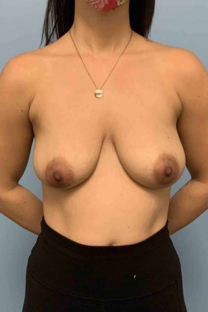 Breast Lift Before & After Patient #12042