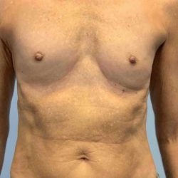 Breast Augmentation Before & After Patient #12049